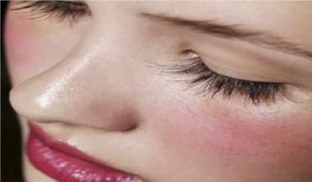 أسباب احمرار الوجه