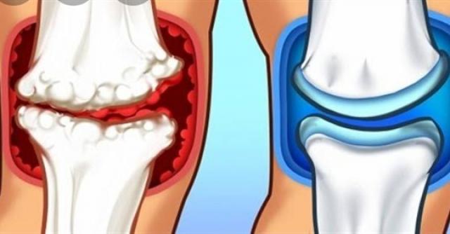 علاج التهاب المفاصل