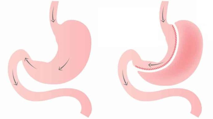 عملية تكميم المعدة مع د. محمد تاج | تعافٍ أسرع وتقنيات حديثة تدعم النجاح