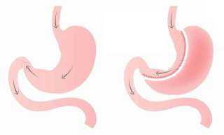 عملية تكميم المعدة مع د. محمد تاج | تعافٍ أسرع وتقنيات حديثة تدعم النجاح